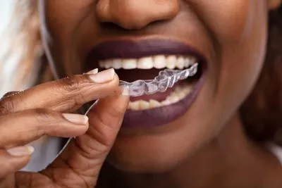 woman putting in her clear aligners to help straighten her teeth